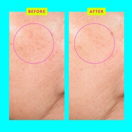 Bouncy Brightfacial™ - Clarifying Face Mask - Ansiktsmask Hyperpigmentering