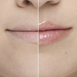 Lip Injection - Extreme