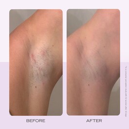 Ingrown Hair Pads - Komposterbara pads för inåtväxande hårstrån x 60