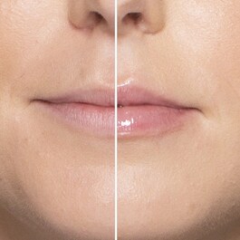 Lip Injection - Extreme